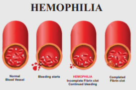 hemophilia