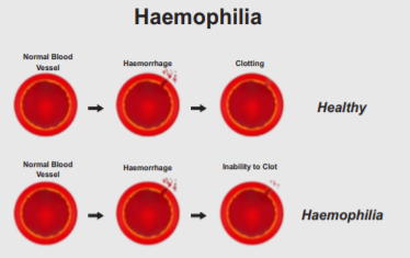 hemophilia