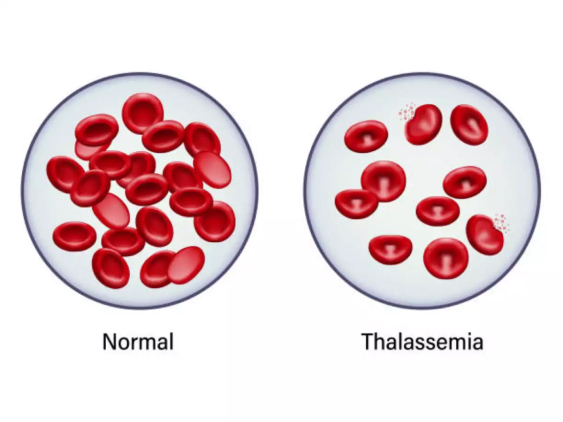 Thalassemia Blood